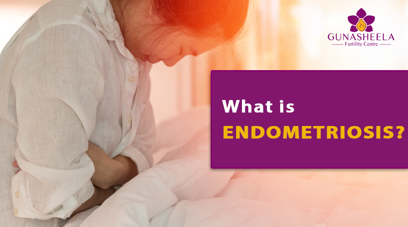 Read more about the article Endometriosis: Causes and Treatments